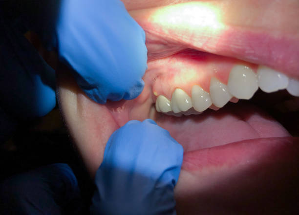 Best Emergency Dental Care for Broken or Chipped Teeth in Thomasville, GA